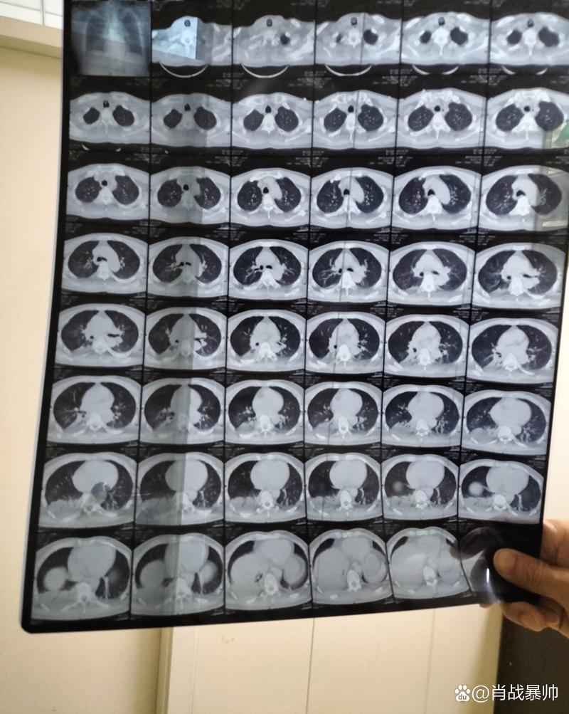 狼疮脑梗心衰35000