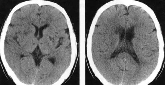 脑ct有病灶就是脑梗吗