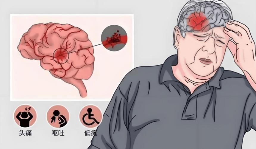 脑梗 失禁 口水 抽搐