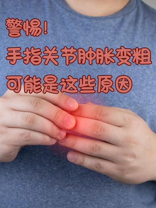 手指风湿与类风湿的区别