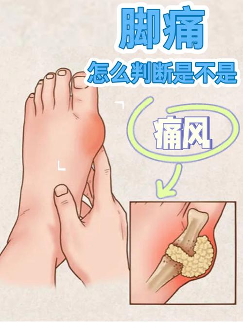 脚趾疼但不是风湿类风湿