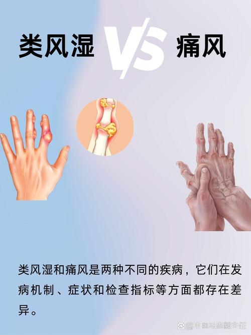 风湿和类风湿有哪些症状