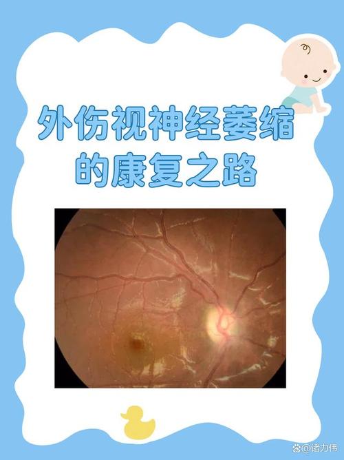 视神经炎 风湿 类风湿