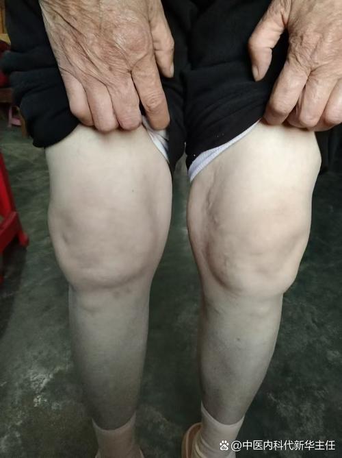 胡氏中医骨科风湿类风湿