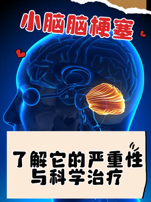 小脑梗和轻微脑梗的区别