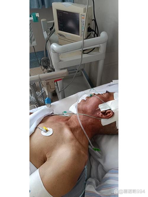 脑梗脑血肿引流管再出血