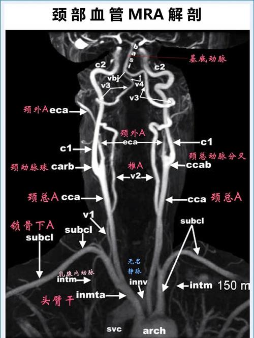 脑动脉狭窄和脑梗不同吗