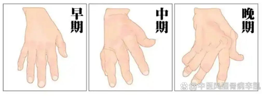 古人不分风湿和类风湿吗