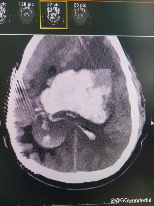 脑梗 术后 出血 ct