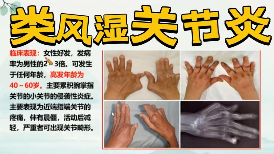 髋骨风湿及类风湿的症状