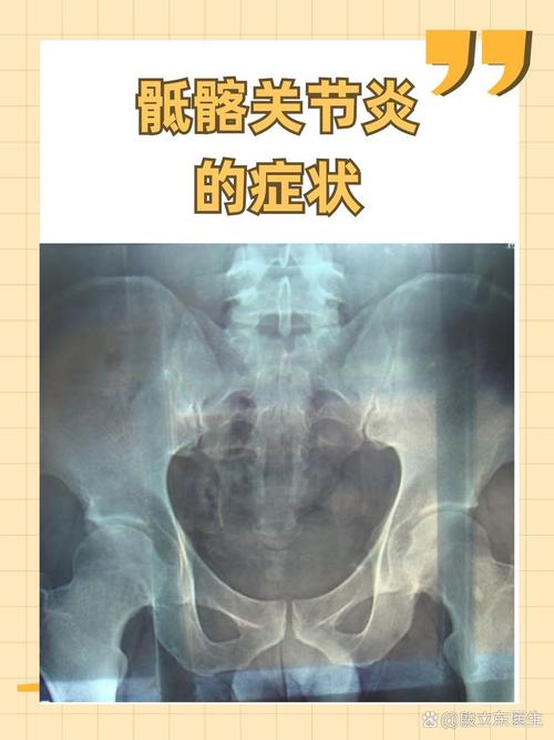 髋骨风湿及类风湿的症状