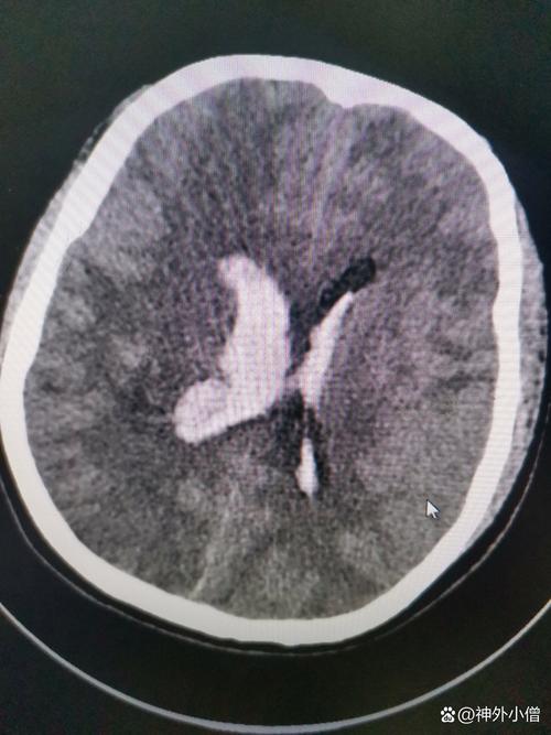 间隙房颤引起脑梗脑渗血