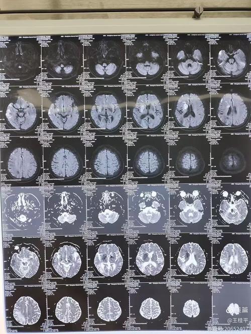 脑ct能基本排除脑梗么