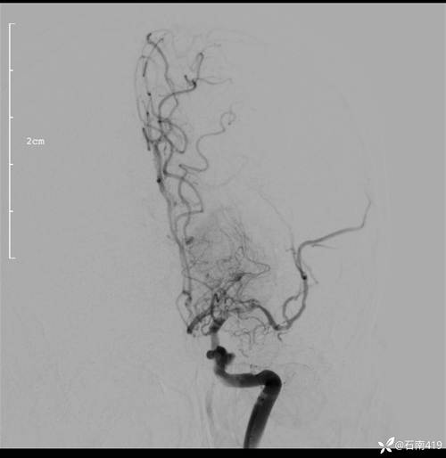 脑梗患者 检查 CTA
