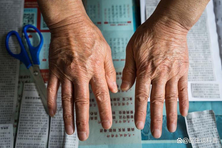 初期风湿类风湿会自愈吗