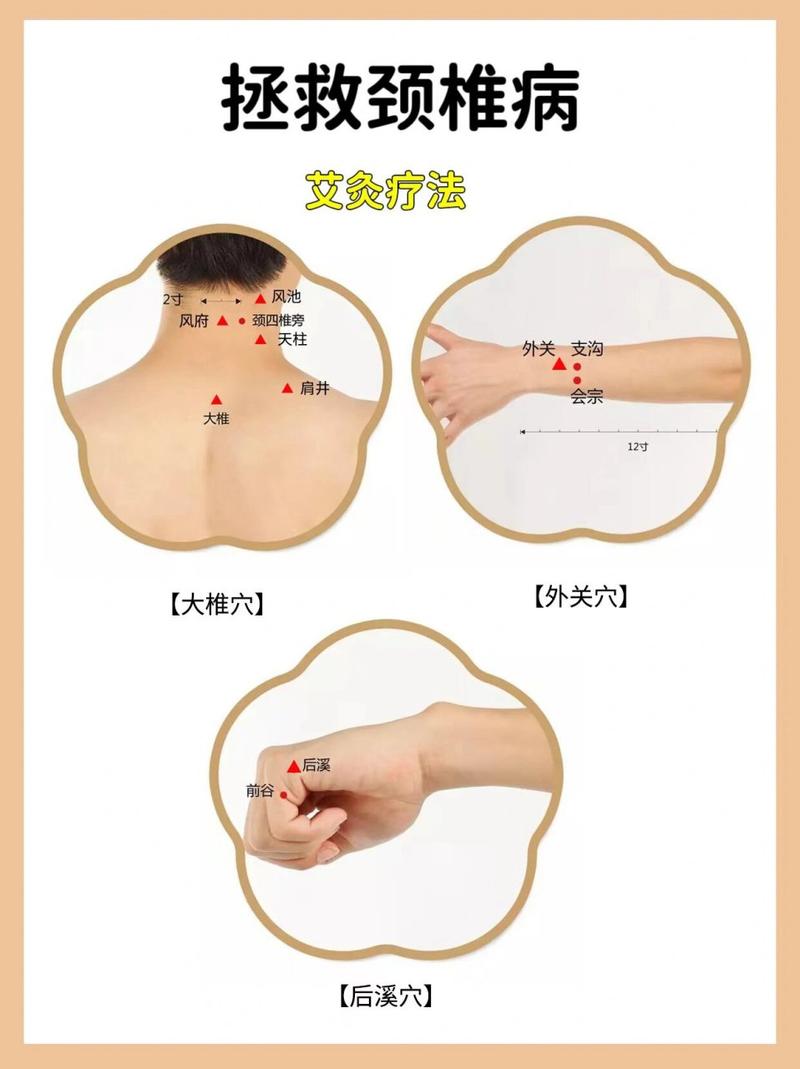 颈椎强直针灸什么穴位