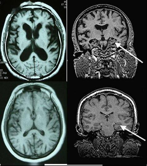 petct能否检查脑梗