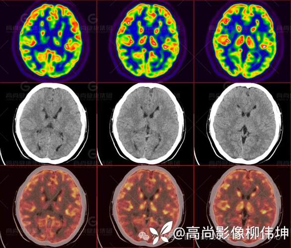 petct能否检查脑梗