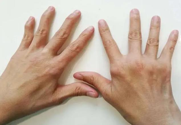 手指关节风湿类风湿土法