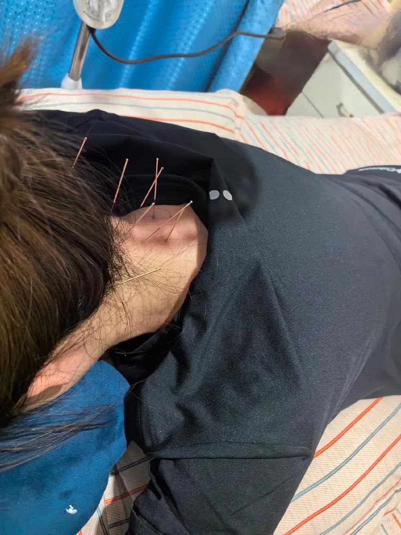 脑梗 针灸 注射 中药