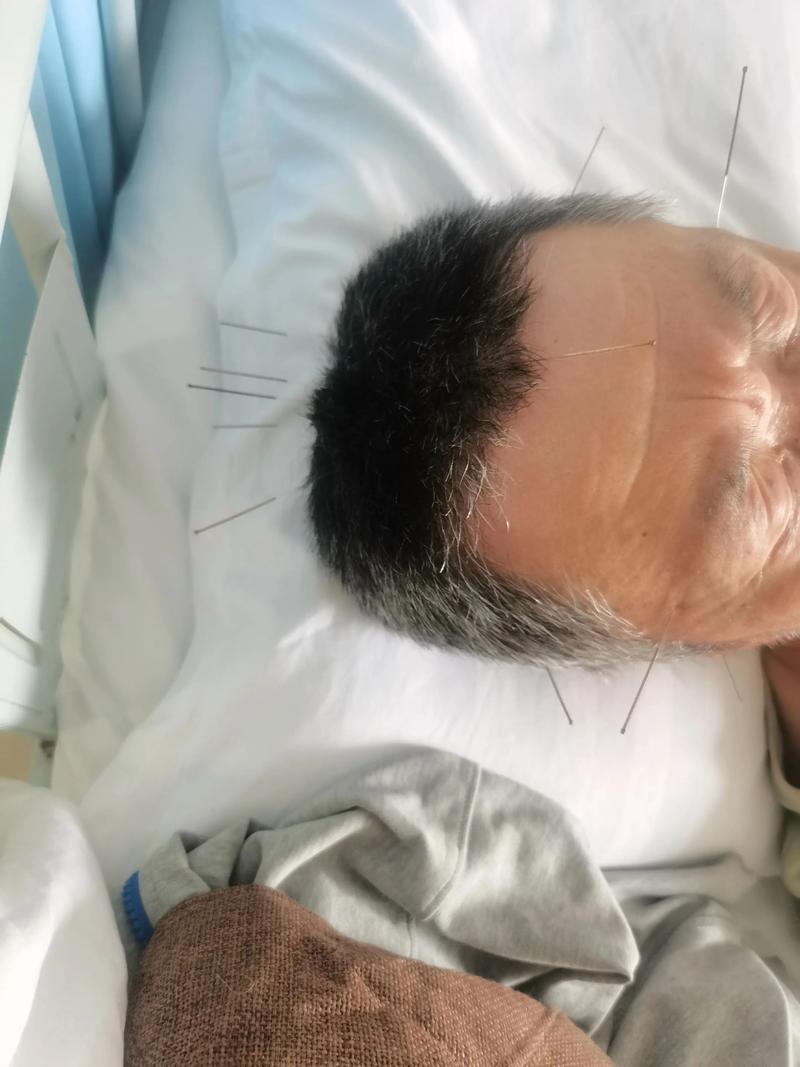脑梗 针灸 注射 中药