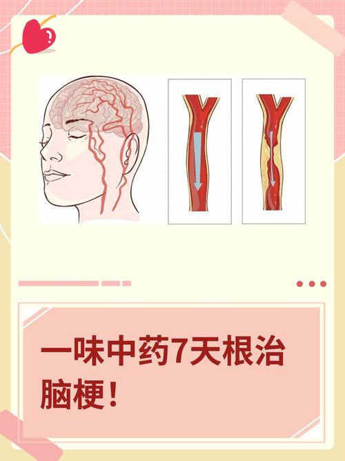 五七脑塞通治疗脑梗好吗