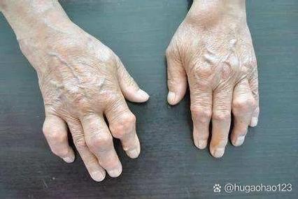 锦州看风湿类风湿哪儿好