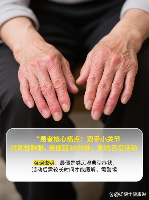 锦州看风湿类风湿哪儿好