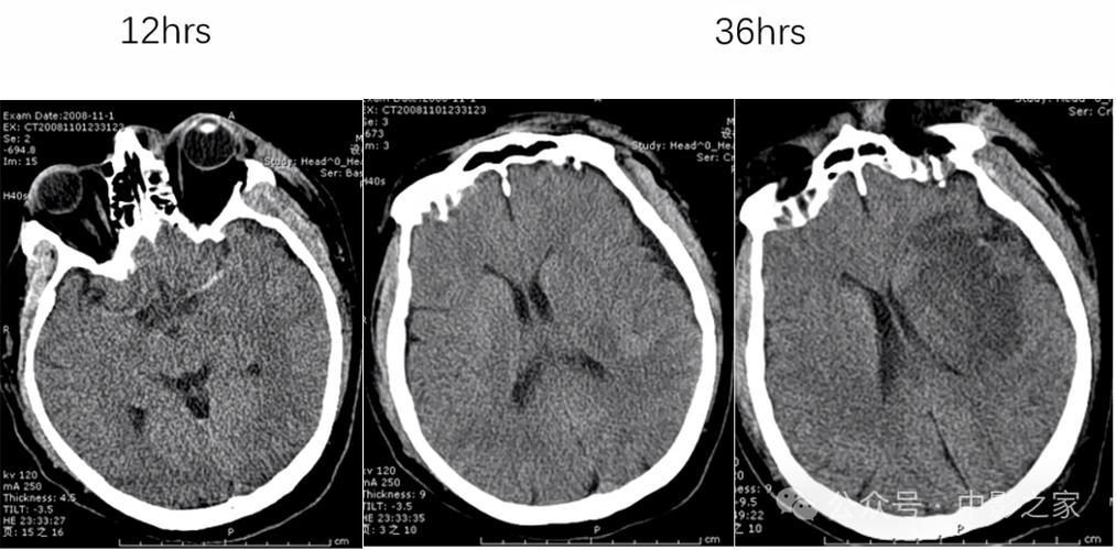 脑ct能看出是否脑梗吗