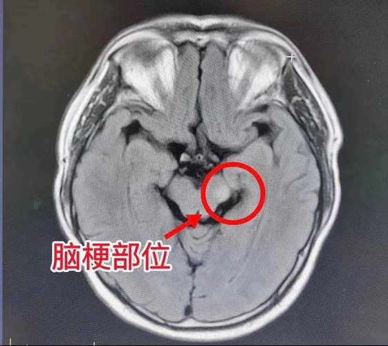 脑ct能看出是否脑梗吗