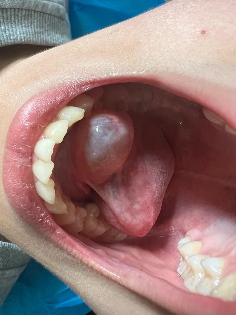 喉管 息肉 破裂 脑梗