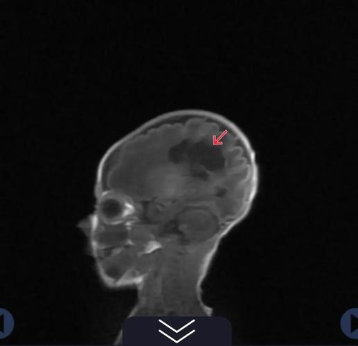 急性脑梗后形成脑软化灶