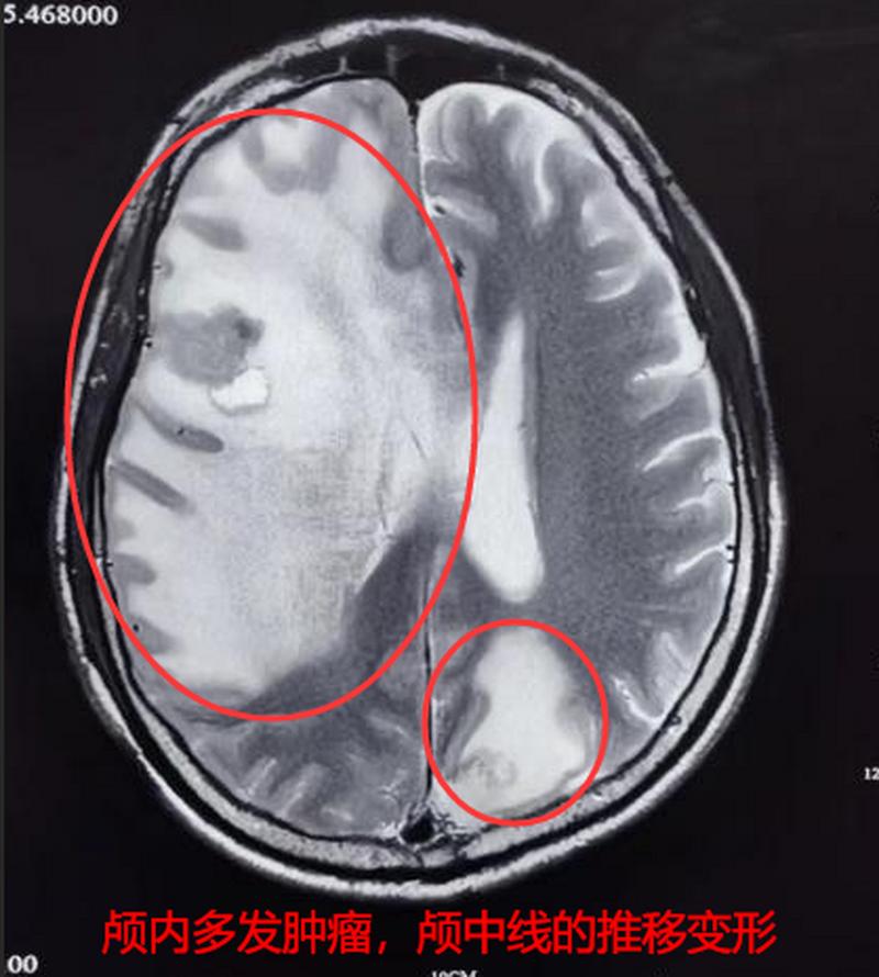 肺腺癌晚期脑转加上脑梗