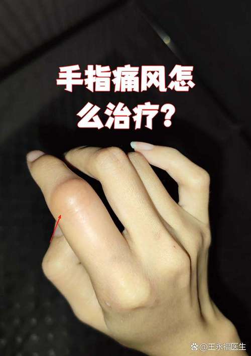 手指肿是风湿还是类风湿