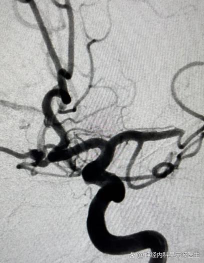 脑梗做脑造影需要买什么