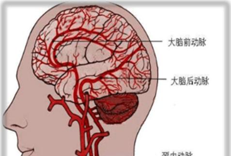 脑血流图可以查出脑梗吗