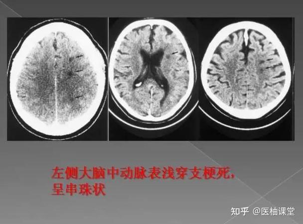 缺血性脑梗和腔隙性脑梗