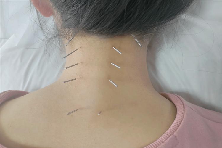 颈部甲状腺的针灸穴位