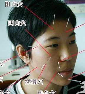 左边面瘫针灸哪些穴位