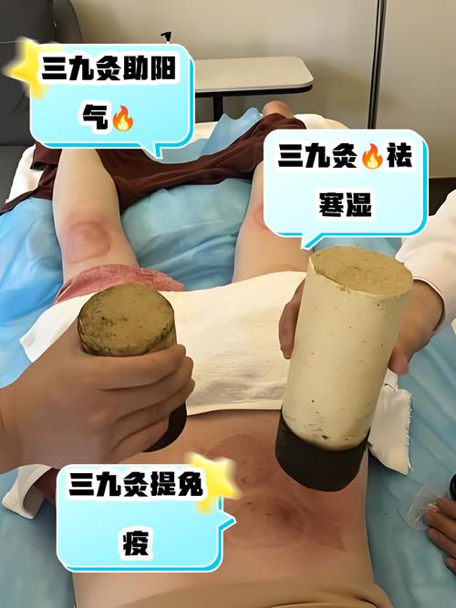 风湿类风湿艾灸有效果吗