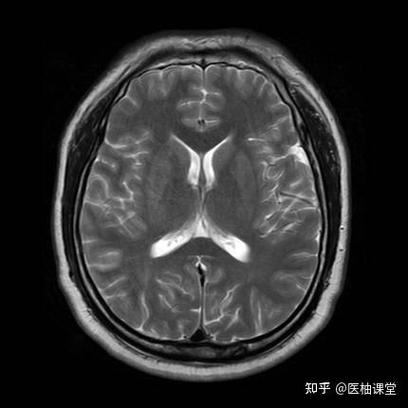 怎样看懂脑ct脑梗图片
