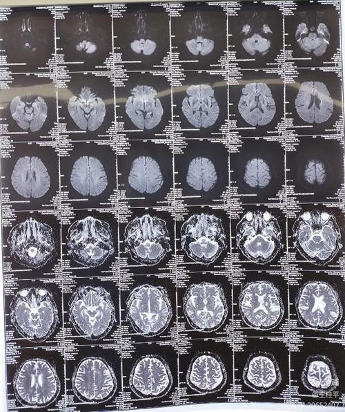右边脑梗一年后左边脑梗