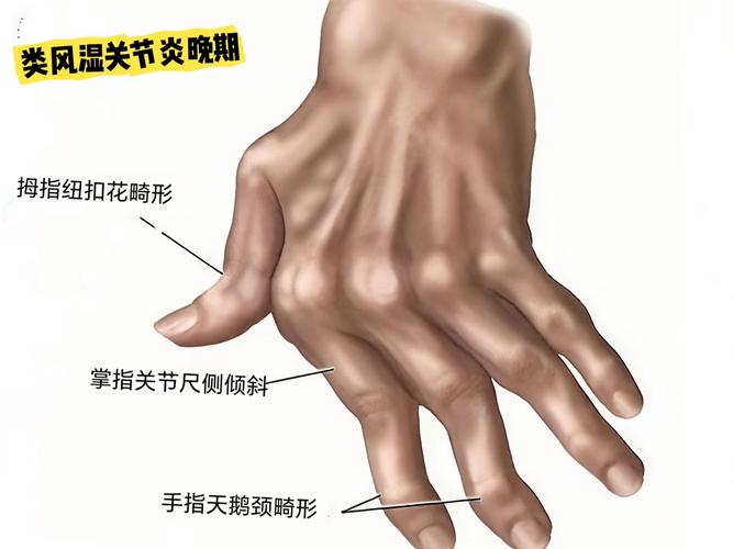 风湿类风湿会影响牙齿吗