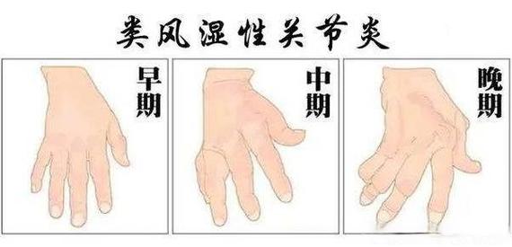 产后风湿会变为类风湿吗