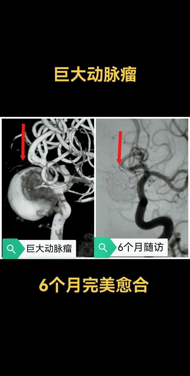 脑 动脉瘤 介入 脑梗