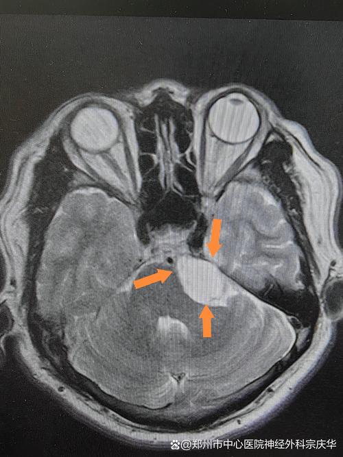 核磁共振 脑肿块 脑梗