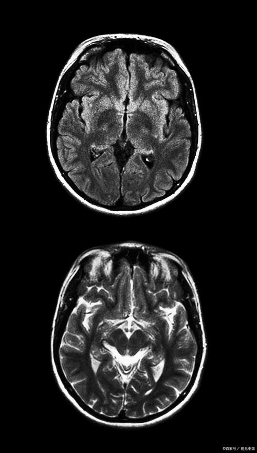 脑梗做脑彩超还是脑ct