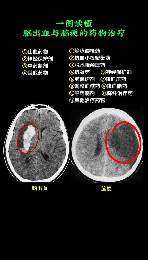 脑梗做脑彩超还是脑ct