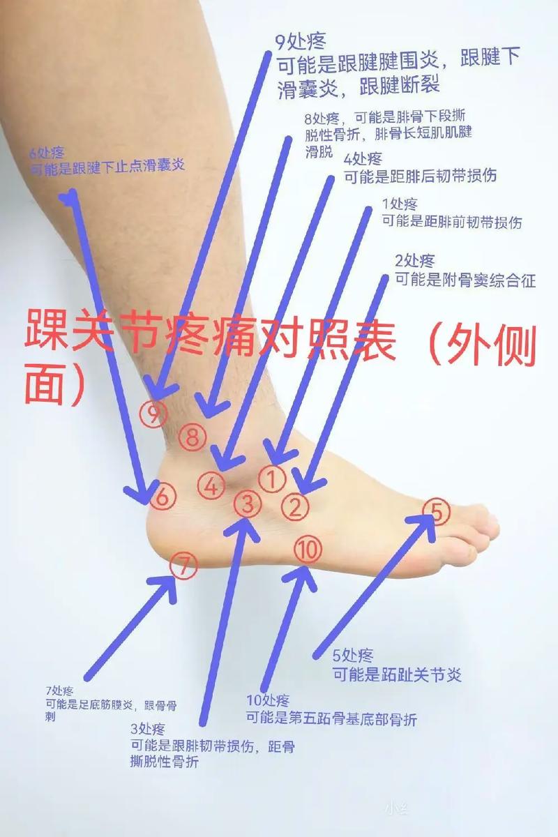 脚踝肿是风湿还是类风湿