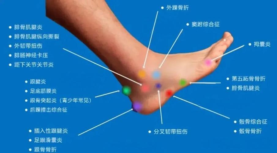 脚踝肿是风湿还是类风湿